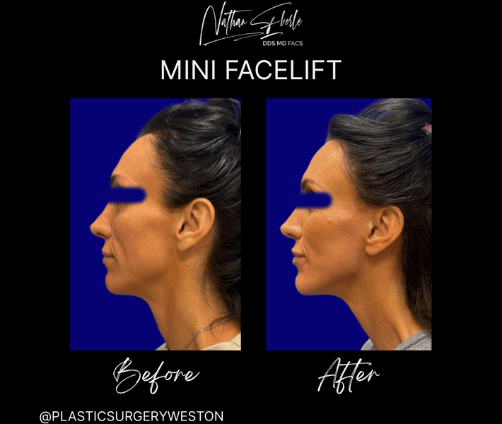 Facelift case 49 before and after results at Weston Center for Plastic Surgery