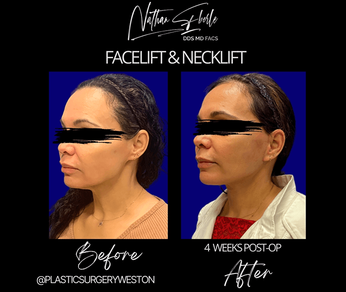 Facelift before and after case 5, actual patient at Weston Center for Plastic Surgery