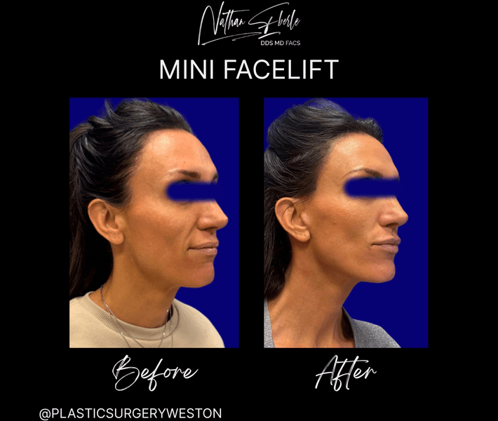Facelift case 50 before and after results at Weston Center for Plastic Surgery
