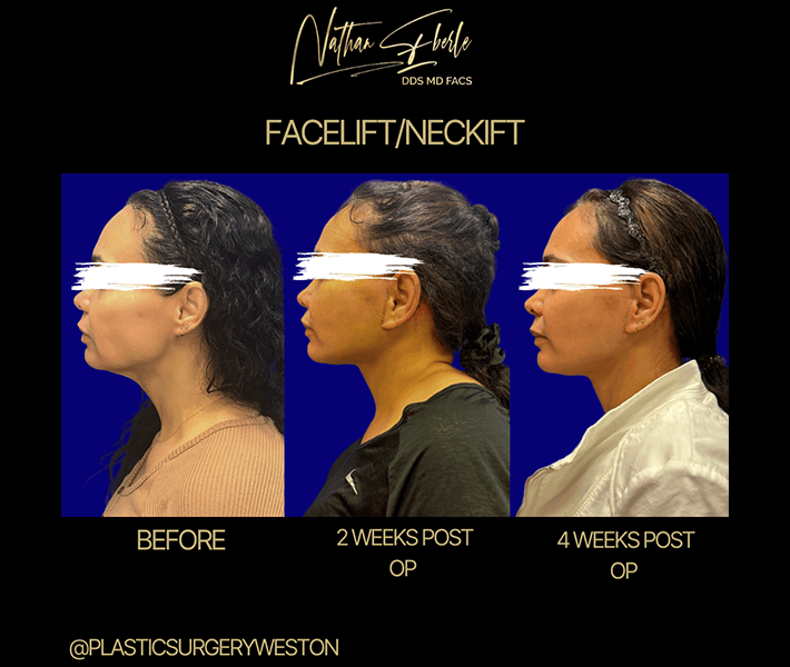 Facelift before and after case 6, actual patient at Weston Center for Plastic Surgery