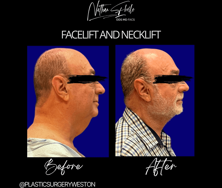 Facelift before and after case 7, actual patient at Weston Center for Plastic Surgery