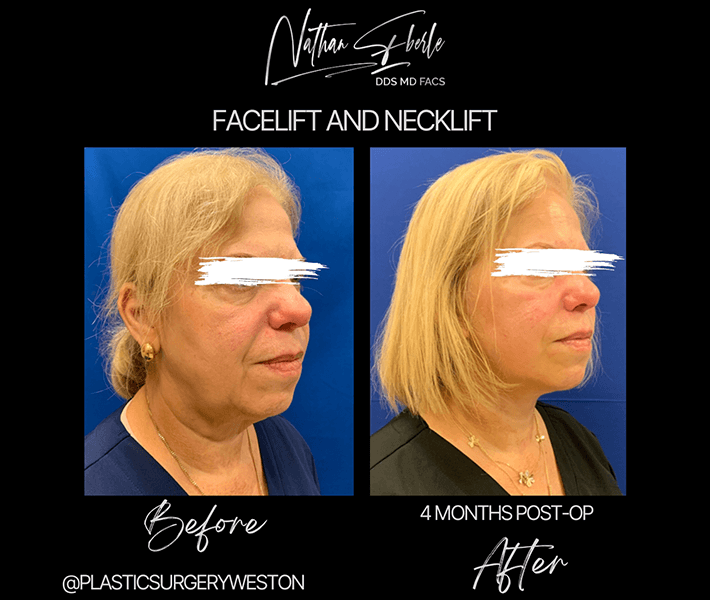 Facelift before and after case 9, actual patient at Weston Center for Plastic Surgery