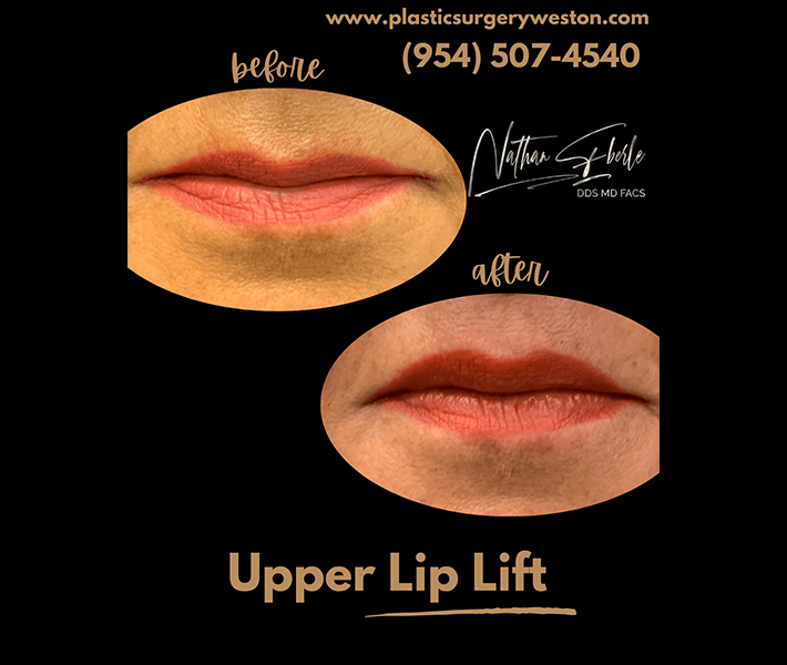 Fillers before and after case 1, actual patient at Weston Center for Plastic Surgery