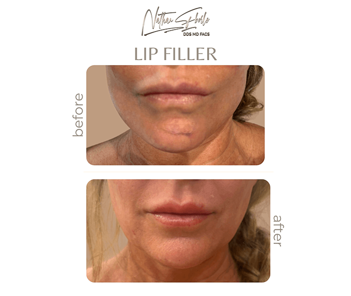 Fillers before and after case 2, actual patient at Weston Center for Plastic Surgery