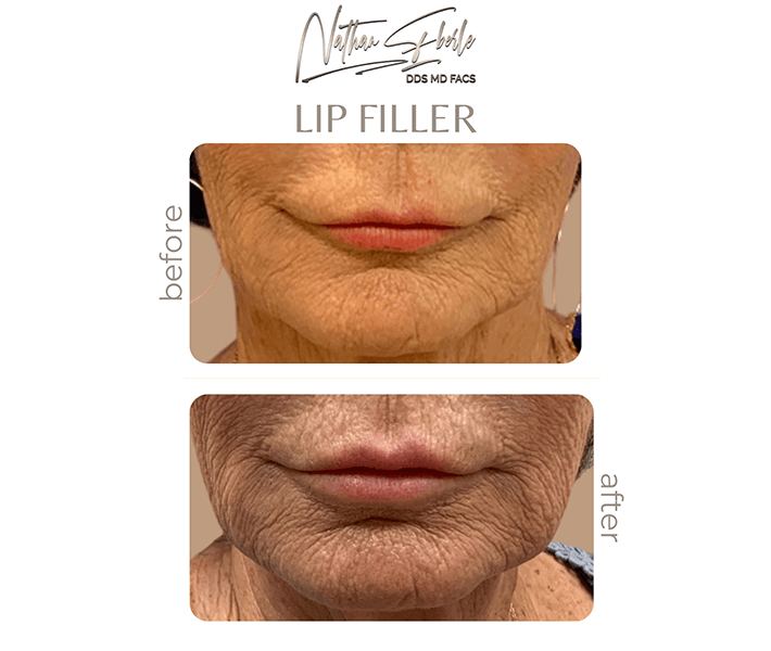 Fillers before and after case 3, actual patient at Weston Center for Plastic Surgery