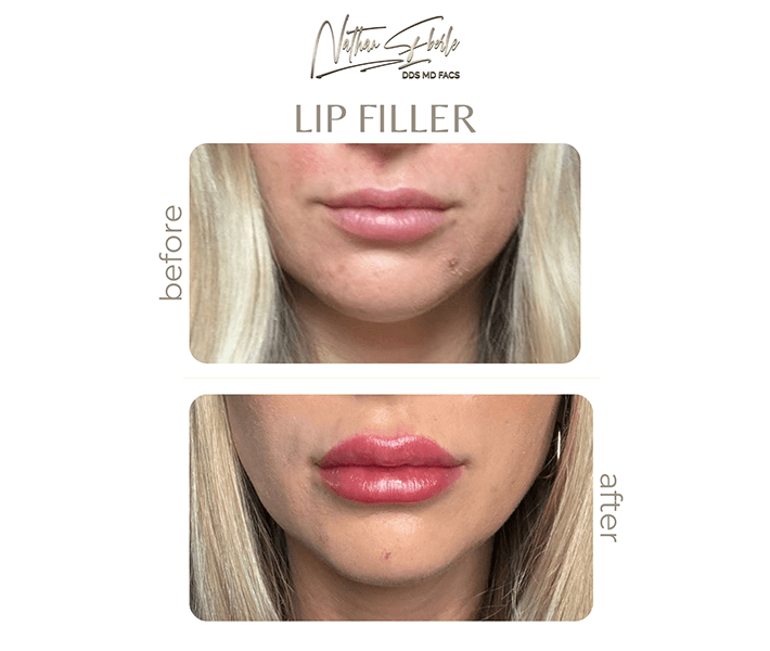 Fillers before and after case 4, actual patient at Weston Center for Plastic Surgery