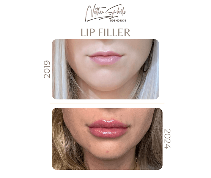Fillers before and after case 5, actual patient at Weston Center for Plastic Surgery