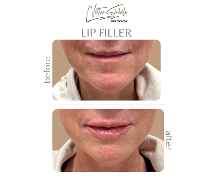 Fillers before and after case 6, actual patient at Weston Center for Plastic Surgery