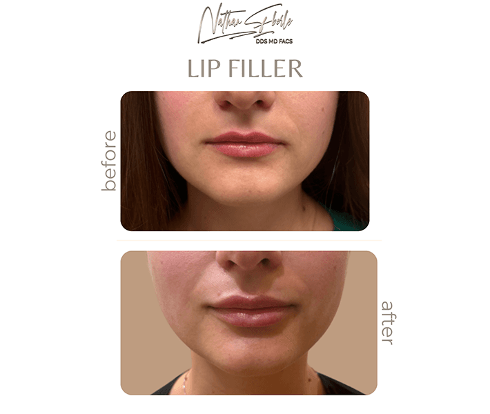 Fillers before and after case 7, actual patient at Weston Center for Plastic Surgery