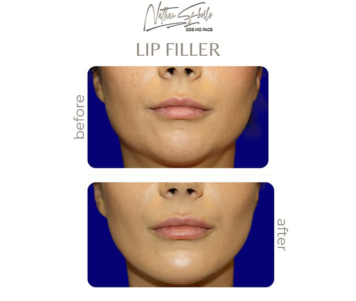 Fillers before and after case 8, actual patient at Weston Center for Plastic Surgery