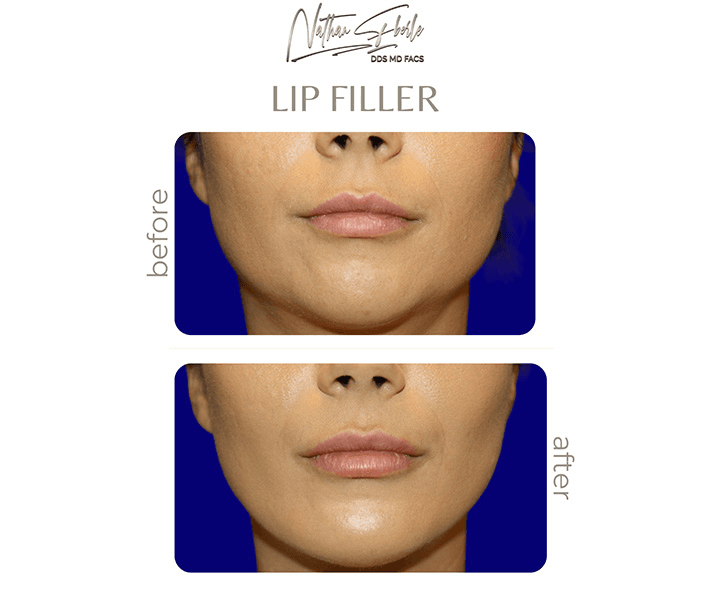 Fillers case 8 before and after results at Weston Center for Plastic Surgery