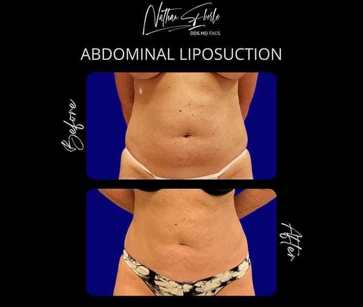 Abdominal Liposuction before and after result 2, actual patient at Weston Center for Plastic Surgery