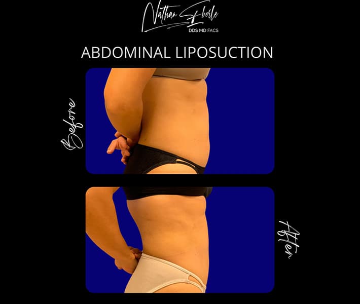 Abdominal Liposuction before and after result 3, actual patient at Weston Center for Plastic Surgery
