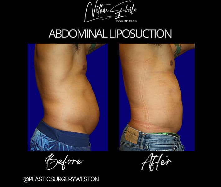 Abdominal Liposuction before and after result 4, actual patient at Weston Center for Plastic Surgery