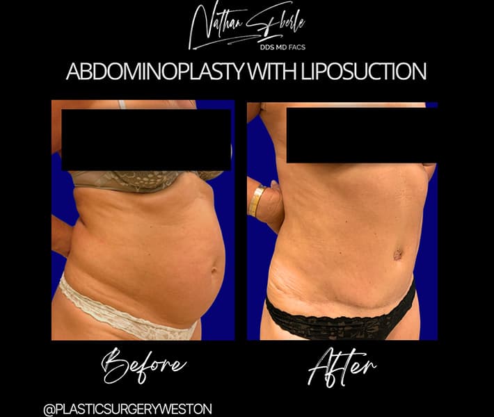 Abdominal Liposuction before and after result 1, actual patient at Weston Center for Plastic Surgery