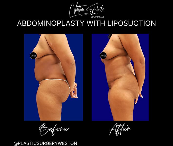Abdominoplasty before and after result 1, actual patient at Weston Center for Plastic Surgery