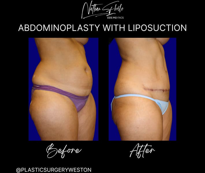 Abdominoplasty before and after result 11, actual patient at Weston Center for Plastic Surgery