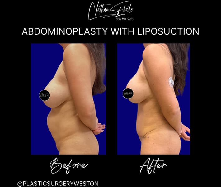 Abdominoplasty before and after result 12, actual patient at Weston Center for Plastic Surgery
