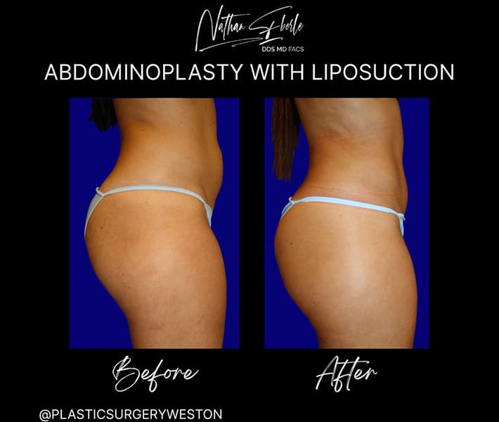 Abdominoplasty before and after result 13, actual patient at Weston Center for Plastic Surgery