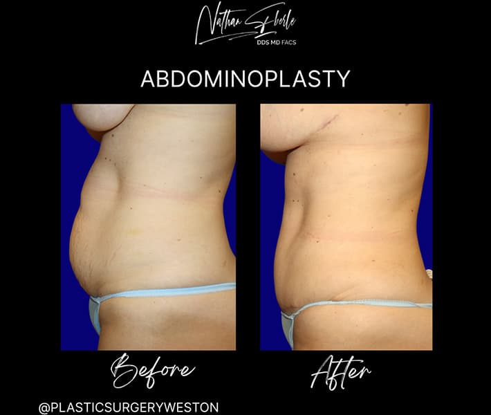 Abdominoplasty before and after result 17, actual patient at Weston Center for Plastic Surgery