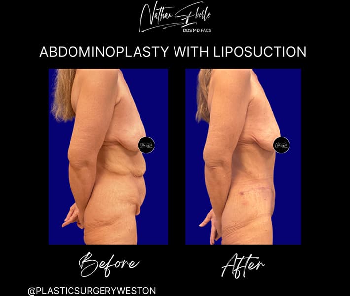 Abdominoplasty before and after result 18, actual patient at Weston Center for Plastic Surgery