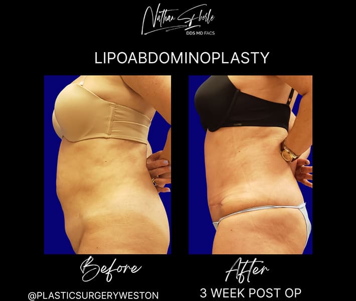Abdominoplasty before and after result 2, actual patient at Weston Center for Plastic Surgery