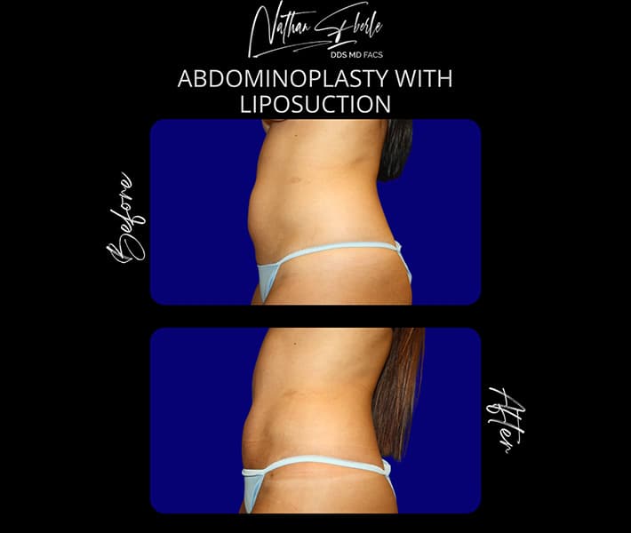 Abdominoplasty before and after result 22, actual patient at Weston Center for Plastic Surgery
