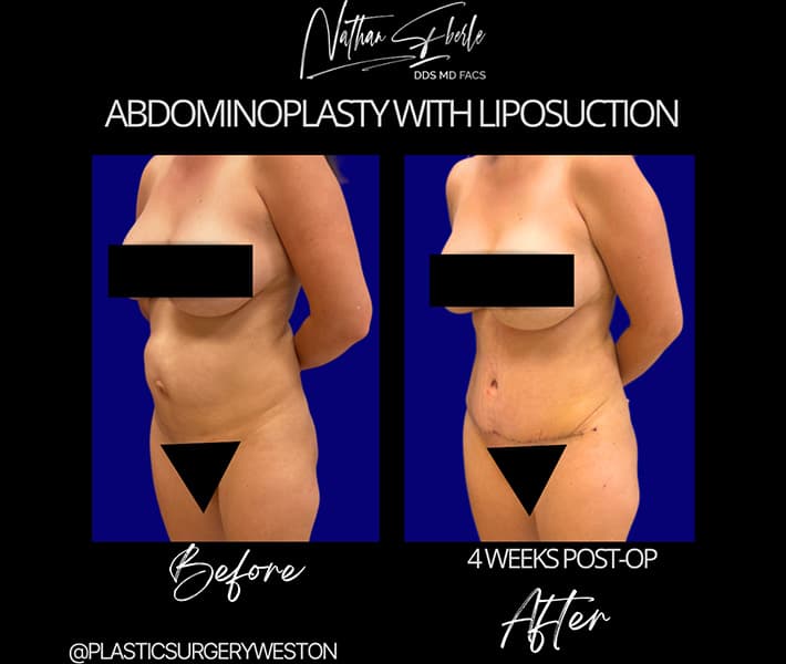 Abdominoplasty before and after result 23, actual patient at Weston Center for Plastic Surgery