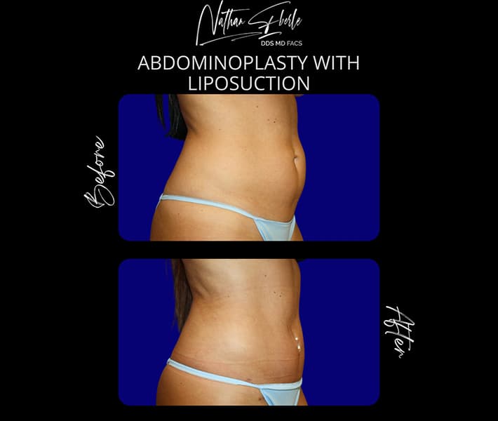 Abdominoplasty before and after result 24, actual patient at Weston Center for Plastic Surgery