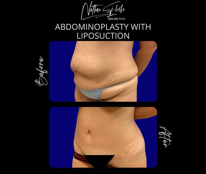 Abdominoplasty before and after result 26, actual patient at Weston Center for Plastic Surgery