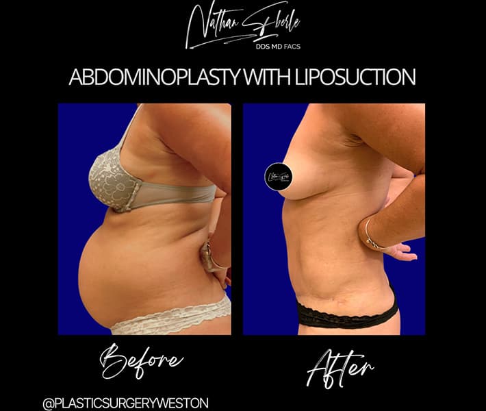 Abdominoplasty before and after result 28, actual patient at Weston Center for Plastic Surgery
