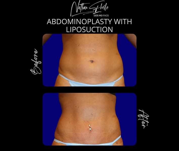 Abdominoplasty before and after result 29, actual patient at Weston Center for Plastic Surgery