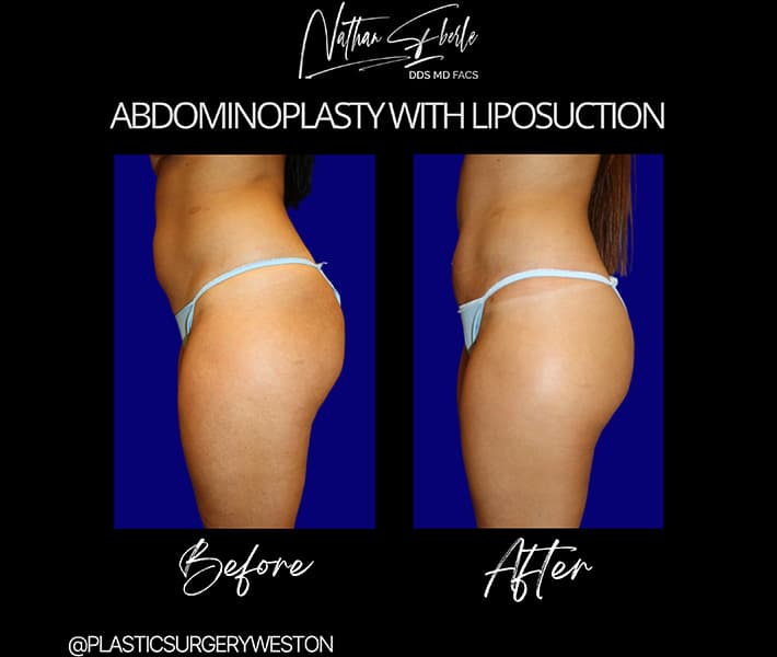 Abdominoplasty before and after result 30, actual patient at Weston Center for Plastic Surgery