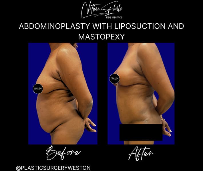 Abdominoplasty before and after result 32, actual patient at Weston Center for Plastic Surgery
