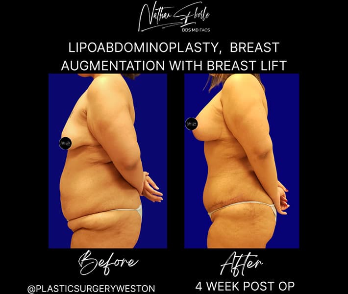 Abdominoplasty before and after result 33, actual patient at Weston Center for Plastic Surgery