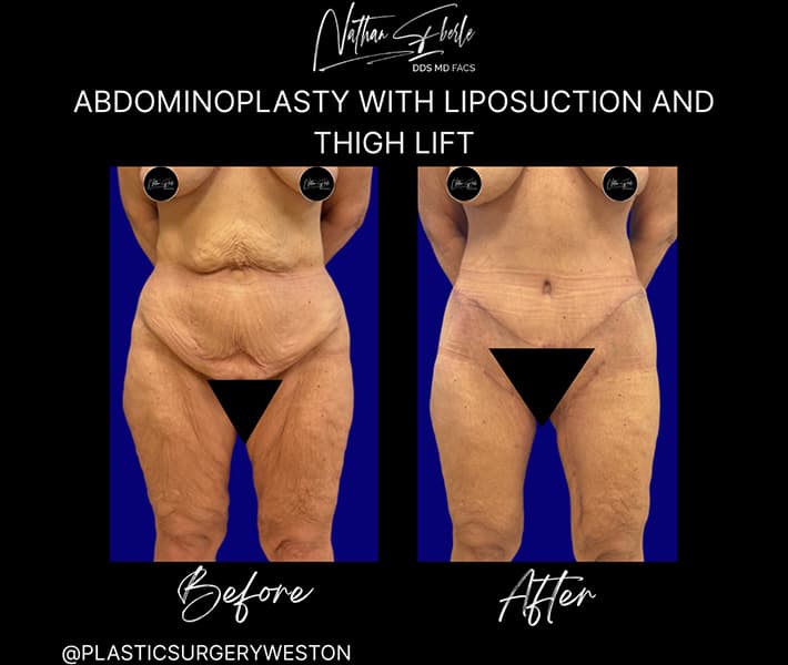 Abdominoplasty before and after result 34, actual patient at Weston Center for Plastic Surgery