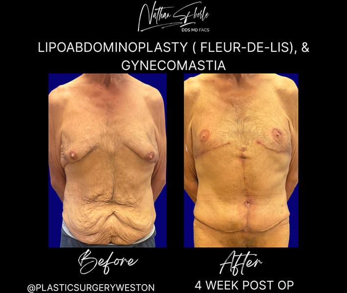Abdominoplasty before and after result 4, actual patient at Weston Center for Plastic Surgery