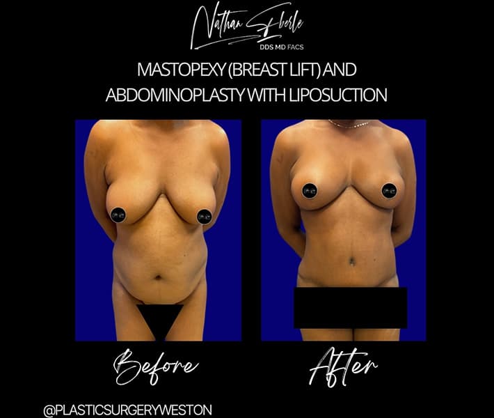 Abdominoplasty before and after result 6, actual patient at Weston Center for Plastic Surgery