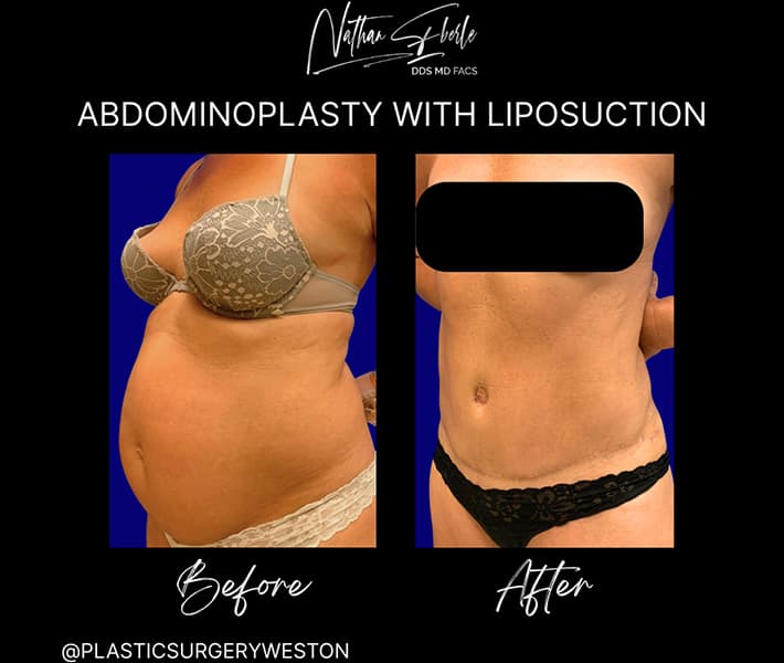 Abdominoplasty before and after result 9, actual patient at Weston Center for Plastic Surgery
