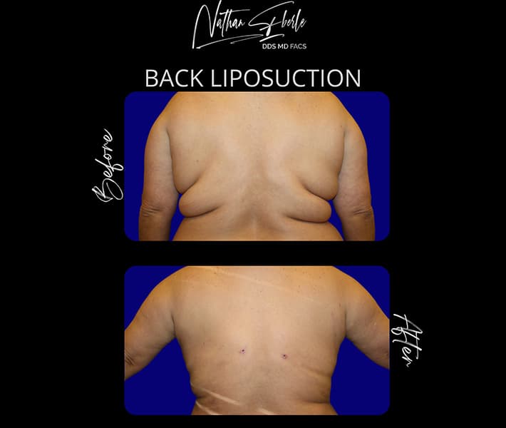 Back Liposuction before and after result 1, actual patient at Weston Center for Plastic Surgery