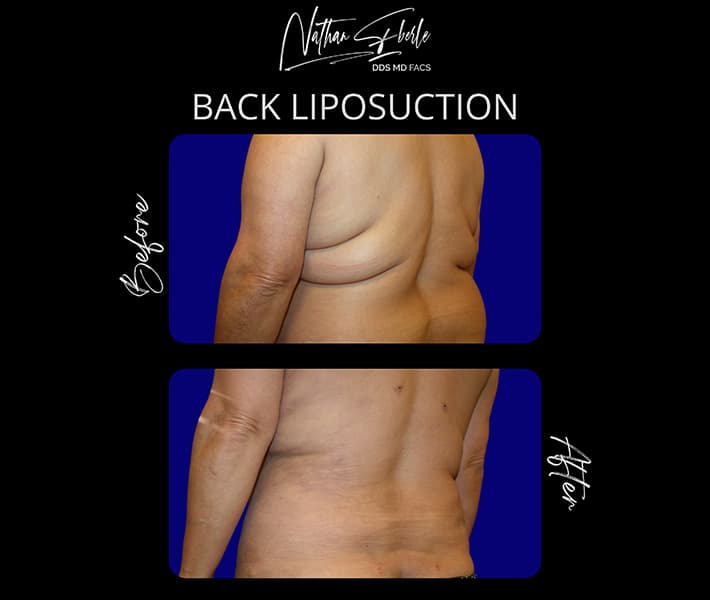 Back Liposuction before and after result 2, actual patient at Weston Center for Plastic Surgery