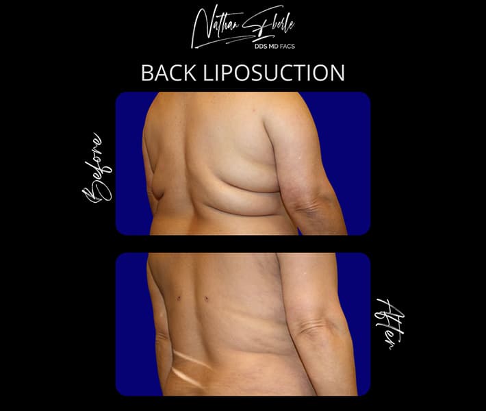 Back Liposuction before and after result 3, actual patient at Weston Center for Plastic Surgery