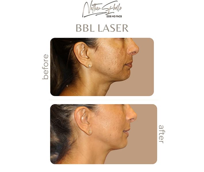 BBL Laser before and after result 1, actual patient at Weston Center for Plastic Surgery