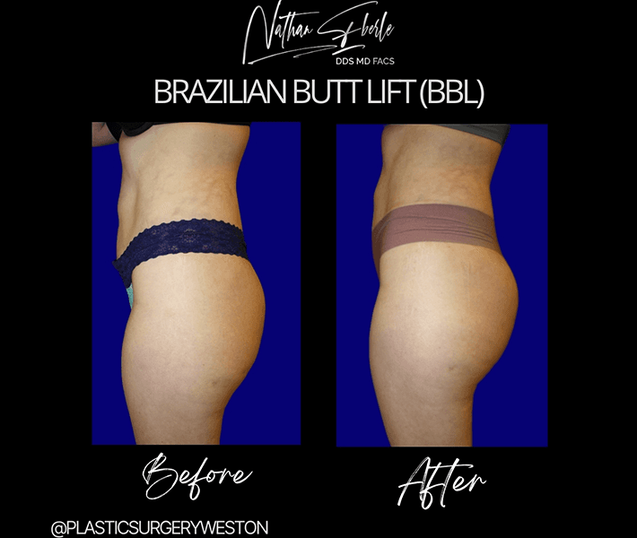 Body Contouring before and after result 5, actual patient at Weston Center for Plastic Surgery