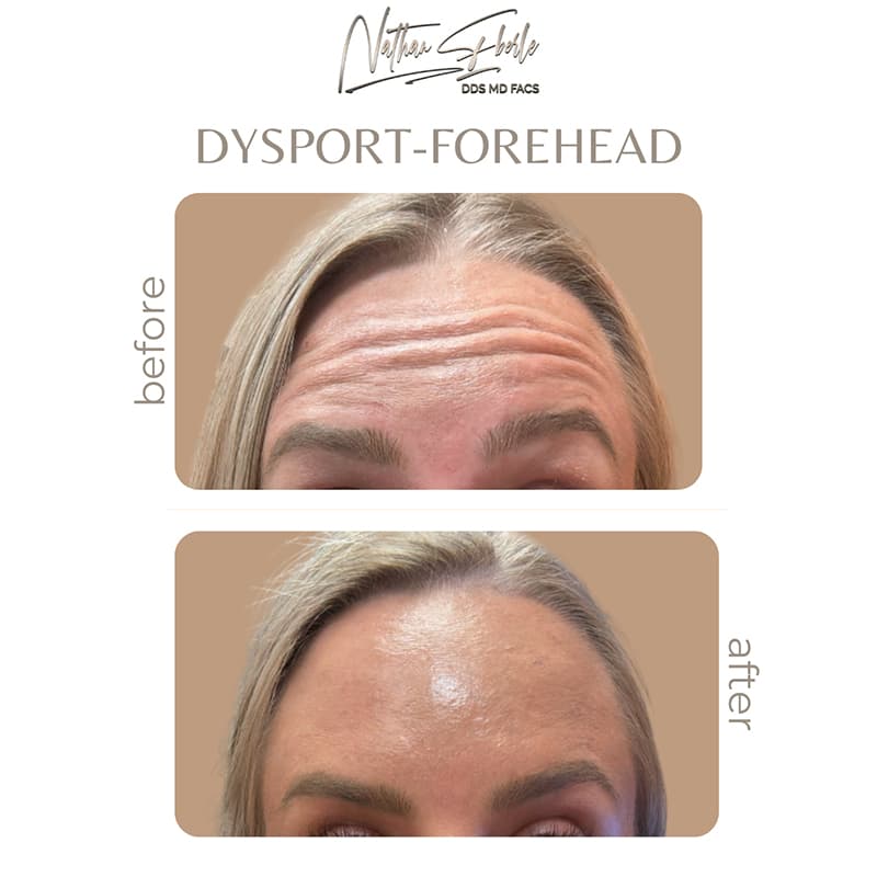 Botox, Jeuveau & Dysport Treatments before and after result 1, actual patient at Weston Center for Plastic Surgery