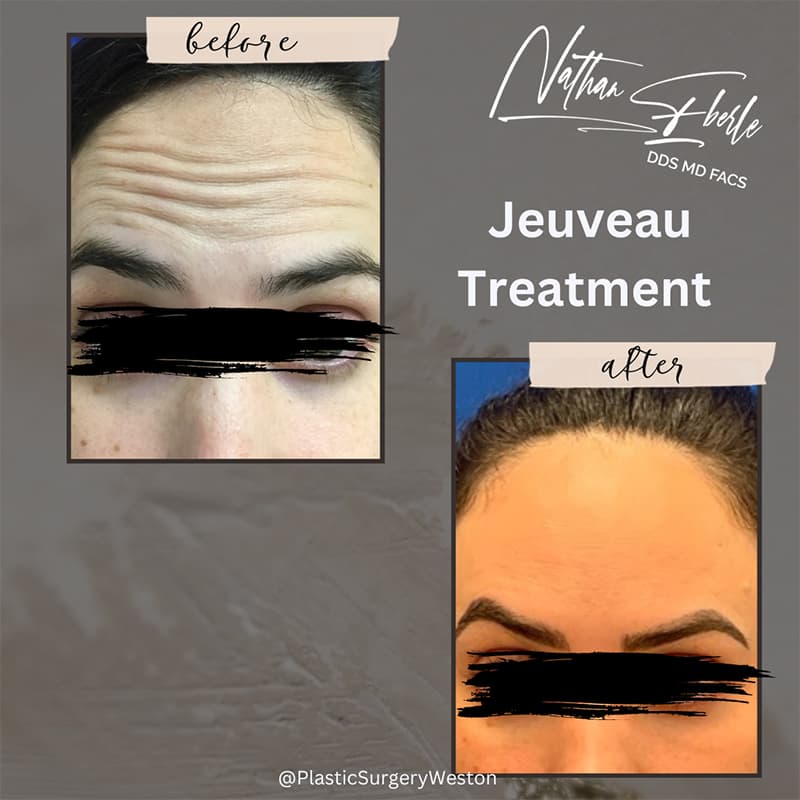 Botox, Jeuveau & Dysport Treatments before and after result 2, actual patient at Weston Center for Plastic Surgery