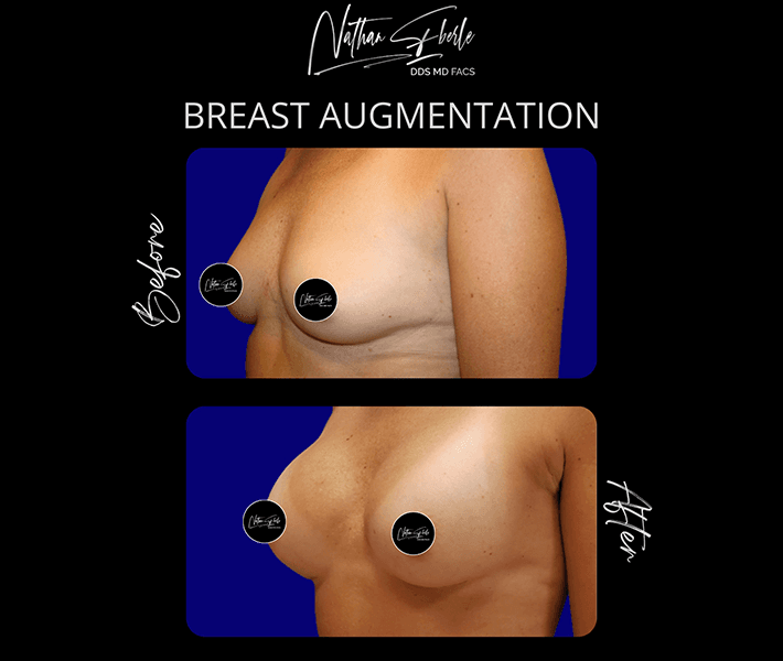 Breast augmentation case 1 before and after