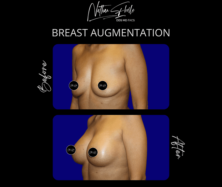 Breast augmentation case 2 before and after
