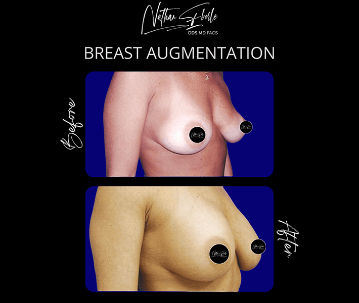 Breast augmentation case 3 before and after