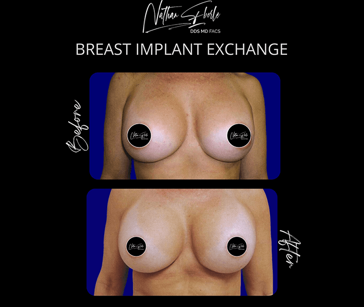 Breast augmentation case 4 before and after